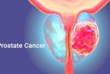 درباره سرطان پروستات بیشتر بدانیم