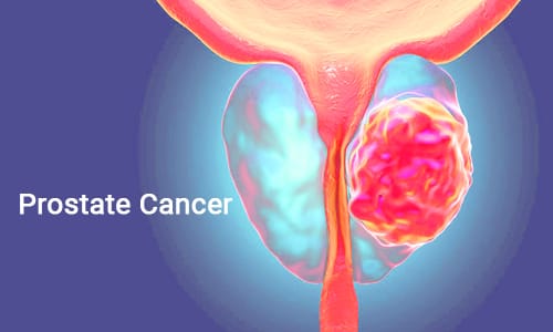 درباره سرطان پروستات بیشتر بدانیم